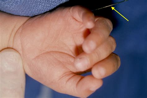 Metacarpal Synostosis Hand Surgery Resource