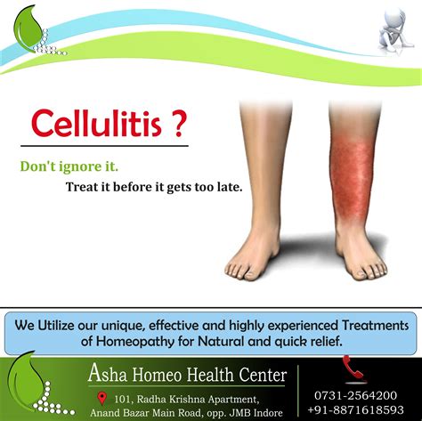 Cellulitis Symptoms Causes Pictures And Treatment Vrogue Co