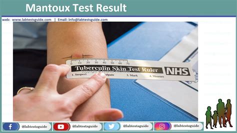 Mantoux Tuberculin Skin Test Porpuse Procedure Results Lab Tests Guide