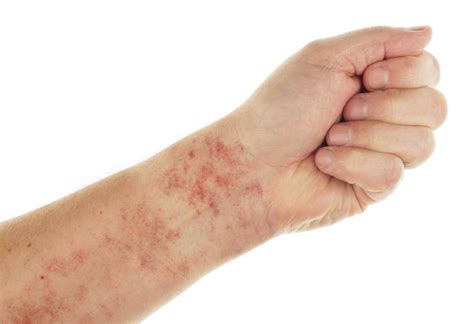Can A Skin Blanching Test Tell You If A Rash Is Serious Experts Explain