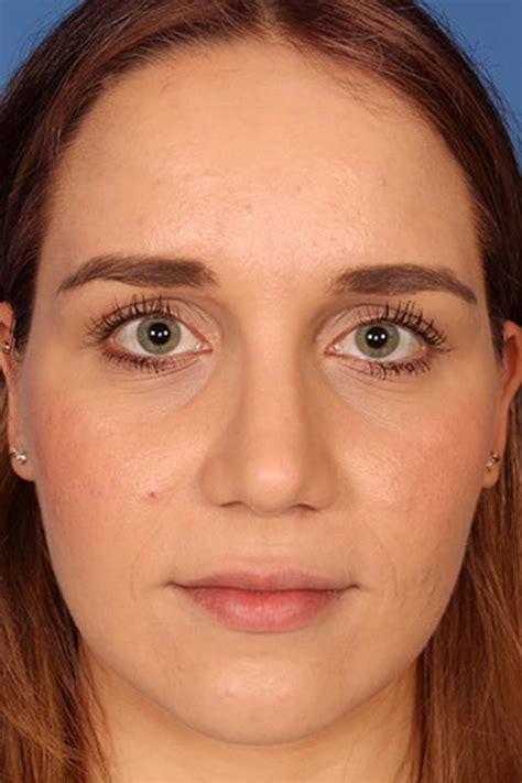 Before And After Rhinoplasty Procedures In Tampa Fl Farrior Facial