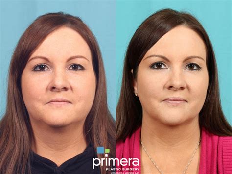Buccal Fat Removal Before And After Pictures Case 599 Orlando