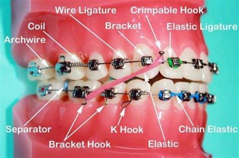 What Are Elastic Ligatures For Orthodontic Braces Archwired