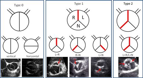 Sex Differences In Phenotypes Of Bicuspid Aortic Valve And Aortopathy Circulation