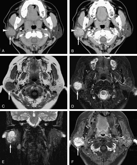 Ct And Mr Images Of Pleomorphic Adenoma In Major And Minor Salivary