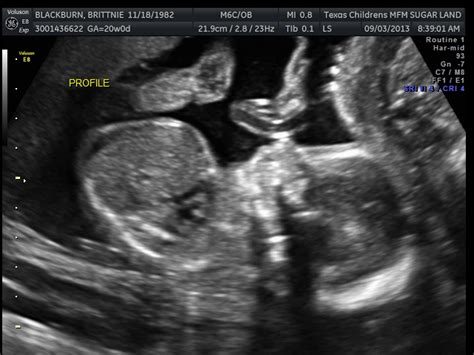 Baby B # 2. . . pink or blue? | A Joy Renewed
