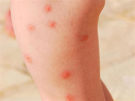 Childhood Rashes Skin Conditions And Infections Photos Babycenter