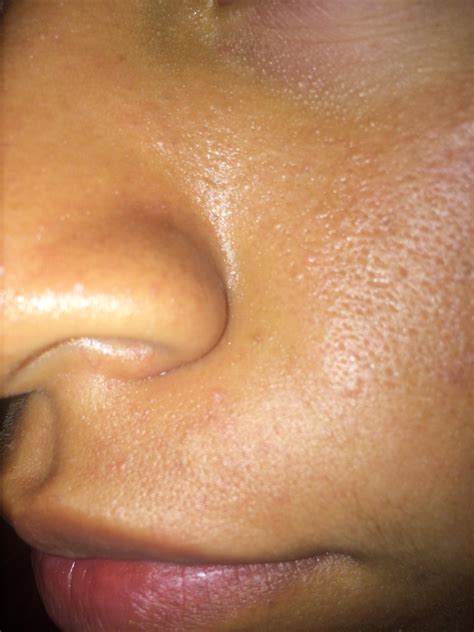 Oily Skin And Stubborn Bumps On Face Oily Skin