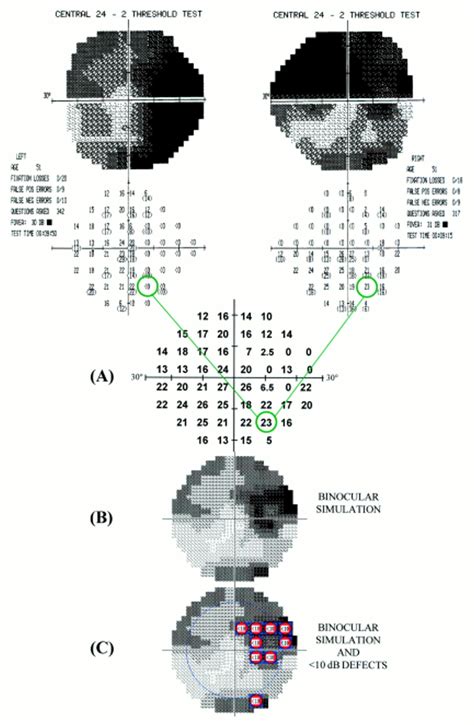 Simulating Binocular Visual Field Status In Glaucoma British Journal