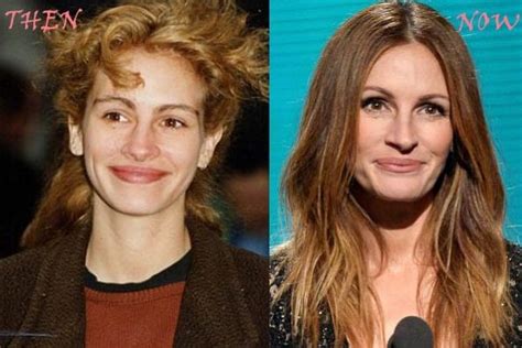 Julia Roberts Plastic Surgery Then And Now Celebrity Plastic Surgery Online