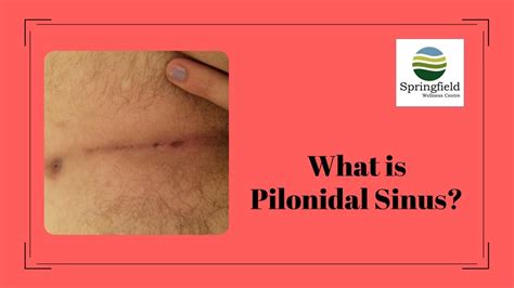 What Is Pilonidal Sinus Dr Maran Youtube