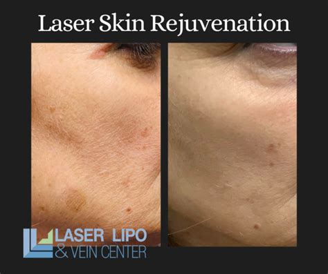 Lumecca Light Therapy Skin Resurfacing Treatments St Louis Liposuction