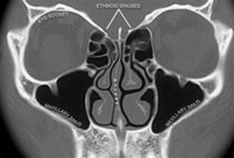 Sinusitis The Cystic Fibrosis Center At Stanford Stanford Medicine