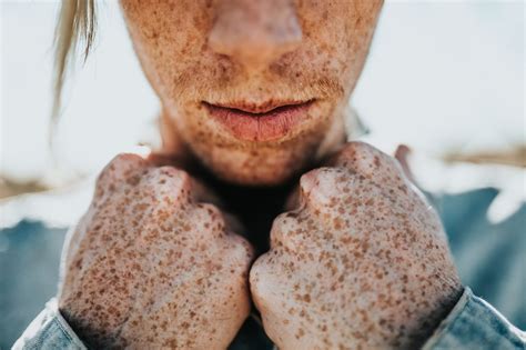 The Truth Behind Freckles And Its Treatment Health And Technology