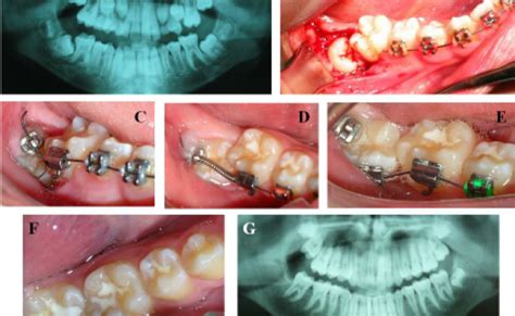 Orthodontic News Uprighting Impacted Mandibular Second Molars Using