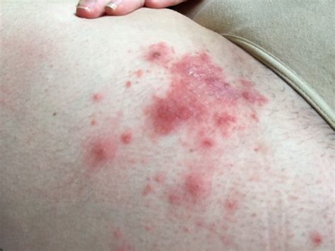 I Have A Rash On My Upper Inner Thigh Could Be Sti And Spreading