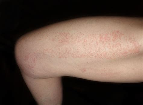 Red Spots On Skin Causes Diagnosis And Treatments