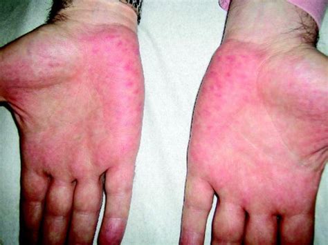 Palmar Erythema Symmetrical Reddening Of The Palms Causes And Treatment