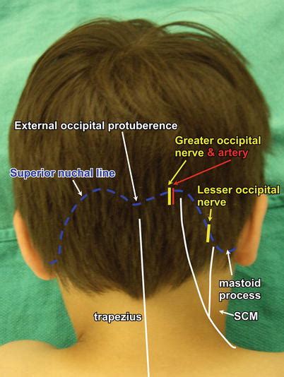 Occipital Nerve Blocks Anesthesia Key