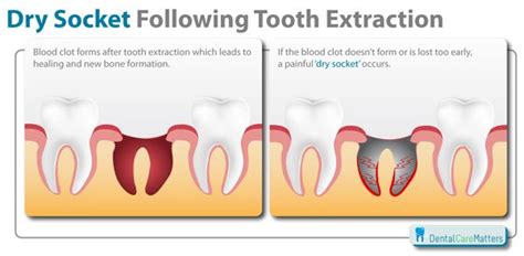 What Is A Dry Socket Tooth Extraction Aftercare Dry Socket After