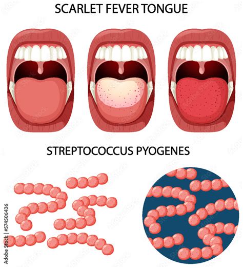 Scarlet Fever Tongue Symptoms Stock Vector Adobe Stock