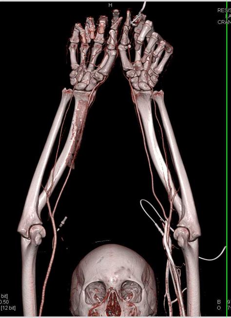 Cta Of The Upper Extremities With Arm Extended Over The Head Vascular