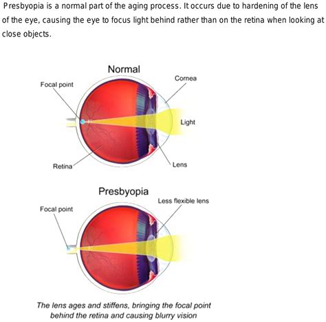 Where Does The Image Form In Eye In The Case Of Presbyopia