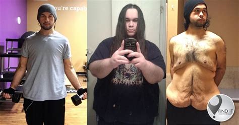Man Accepts His Excess Skin Because Of His Weight Loss