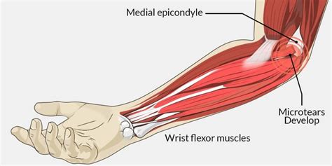 Golfers Elbow What Is It What Causes It How Do We Treat It