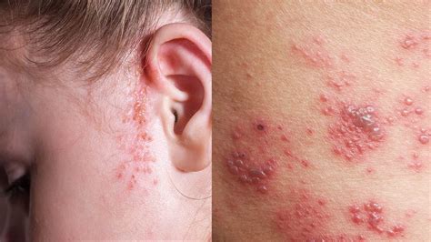 10 Rashes That Could Reveal A Dermatologic Disease Types Of Rashes
