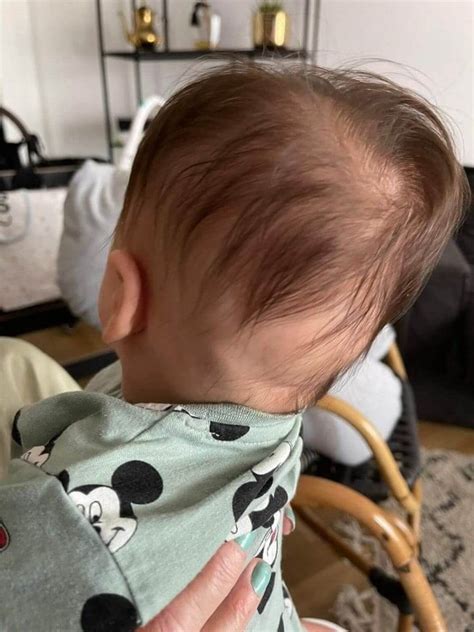 Plagiocephaly Flat Head Syndrome In Infants