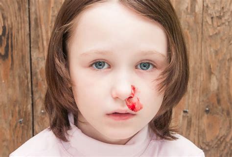 These types of nosebleeds can usually be treated at home. Gas Compressors And Nose Bleeds - PopularResistance.Org