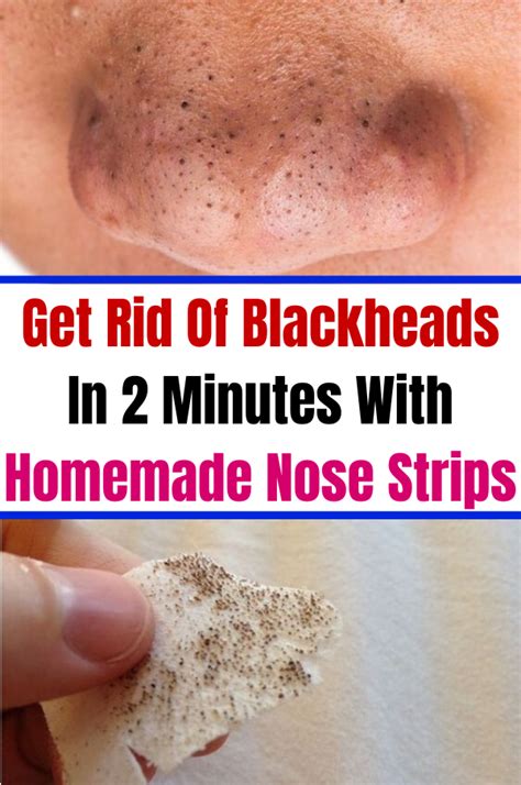 Get Rid Of Blackheads In 2 Minutes With Homemade Nose Strips