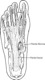 Although conditions of the achilles. plantarfibromatosis of foot, yay for me | Information ...