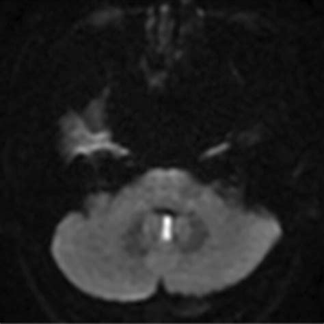 Diffusion Weighted Magnetic Resonance Imaging Demonstrated An Isolated