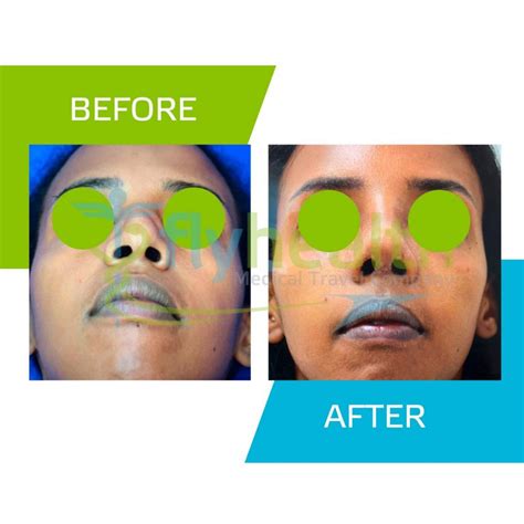 Nose Surgery Before And After Gallery See The Differences