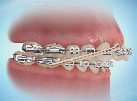 What Are Orthodontic Rubber Bands Elastics And How Do They Work David H Lee Dds Msd Board