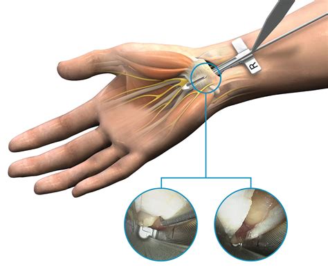 Endoscopic Carpal Tunnel Release Ectr Trice Medical