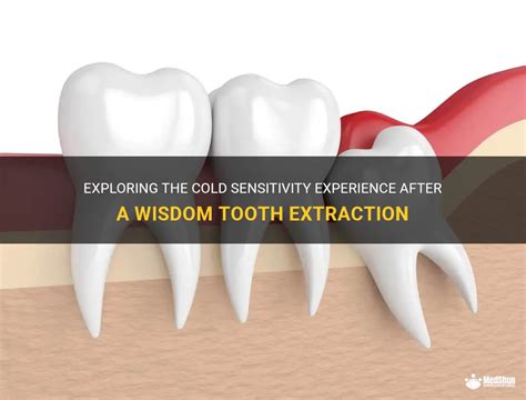 Exploring The Cold Sensitivity Experience After A Wisdom Tooth
