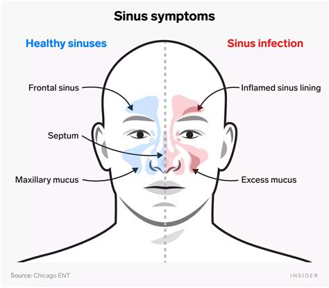 Can a sinus infection cause headaches: Sinus headaches – Symptoms