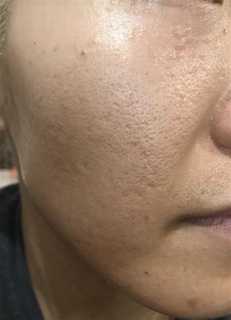 Skin Concerns 30f Still With Acne Atrophic Scar Treatment And Mental