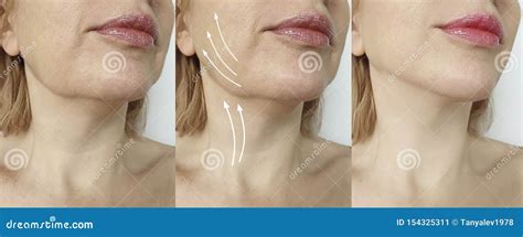 Woman Double Chin Before And After Treatment Correction Stock Image