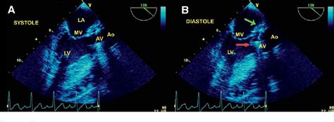 Figure 1 From Prosthetic Aortic Valve Endocarditis Complicated With