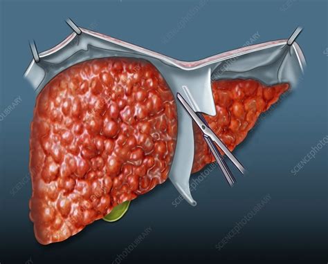 Liver Transplant Illustration Stock Image C0393083 Science