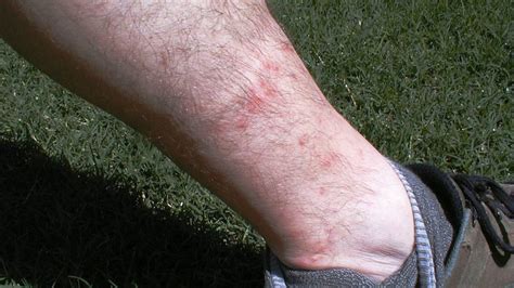 Chiggers And No See Ums How To Avoid Or Treat The Bites Raleigh News