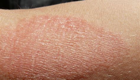 Types Of Eczema Which Are Common