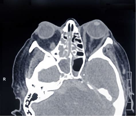 Cavernous Sinus Thrombosis Due To Ipsilateral Sphenoid Sinusitis Bmj