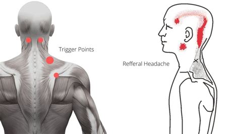 7 Home Exercises For Cervicogenic Headaches That Actually Work