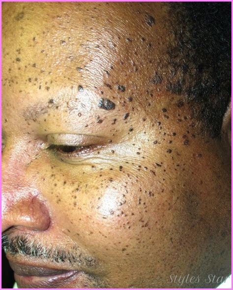 What Can I Do About The Brown Spots On My Face Stylesstarcom