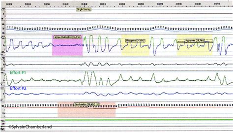 Sleep Apnea Pathophysiology Signs And Symptoms Dr Sylvain